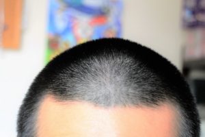 【抗がん剤】脱毛前にバリカンしてよかったと心底思った5つの理由